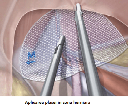 Operatie hernie epigastrica laparoscopica romania