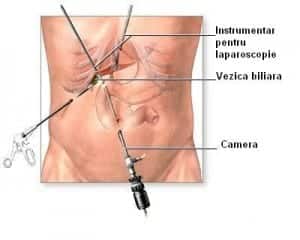 colecistectomie laparoscopica