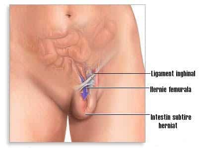 Hiserectomie totala +hernie abdominala operate impreuna.