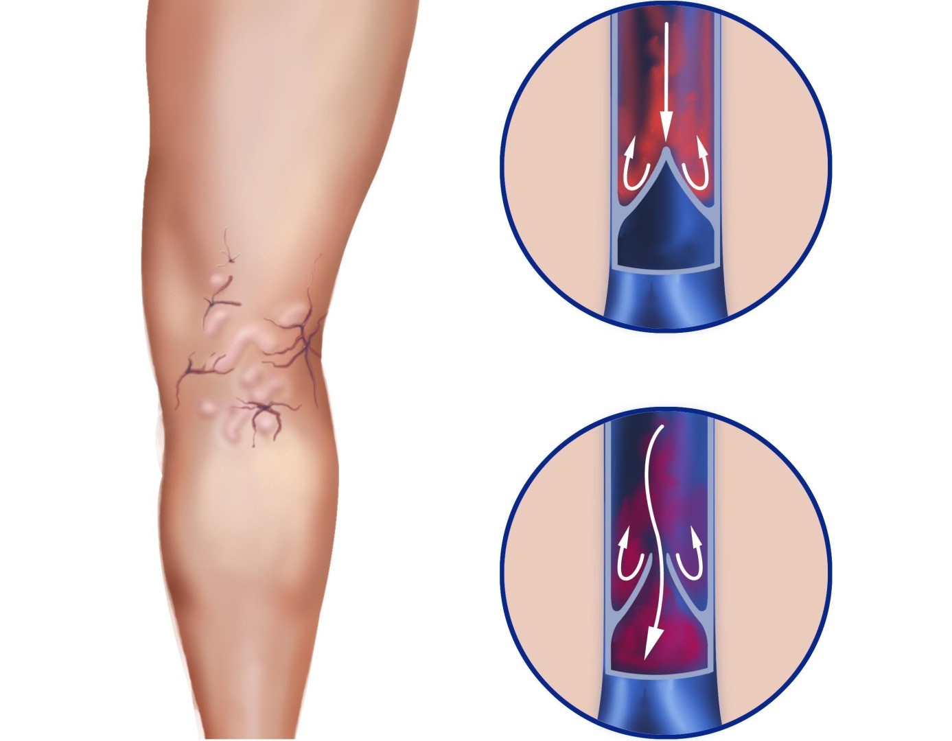 tratamentul chirurgical al venelor varicoase ale extremitailor inferioare perforating veins lower leg
